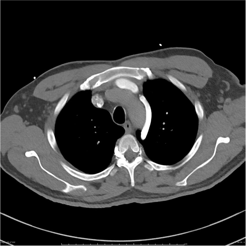 Azygos venous system anatomy (CT pulmonary angiography) (Radiopaedia 25928-26077 Axial C+ CTPA 18).jpg