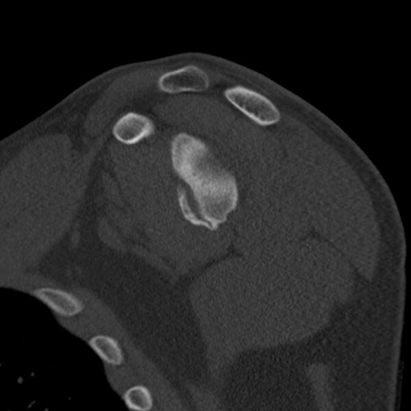 File:Bankart lesion (Radiopaedia 22771-22798 Sagittal bone window 28).jpg