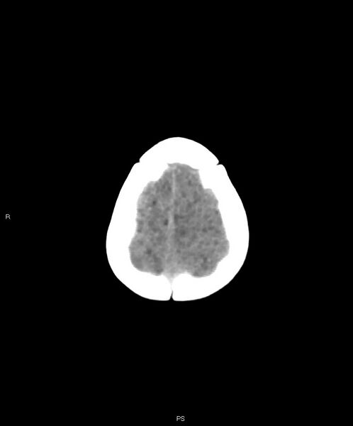 File:Basal ganglia and parenchymal ischemia (Radiopaedia 45818-50083 Axial non-contrast 4).jpg