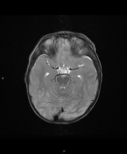 File:Basal ganglia and parenchymal ischemia (Radiopaedia 45818-50084 Axial T2 8).jpg