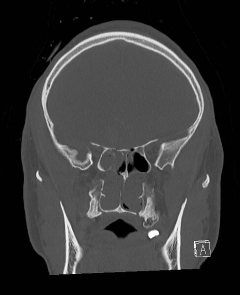 File:Base of skull fracture with bilateral Le Fort fractures (Radiopaedia 47094-51638 Coronal bone window 65).jpg
