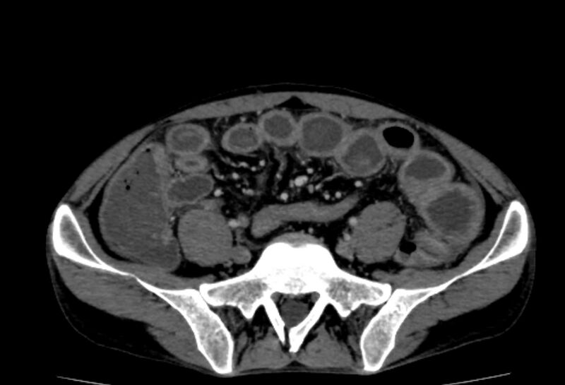 File:Behçet's disease- abdominal vasculitis (Radiopaedia 55955-62570 A 63).jpg