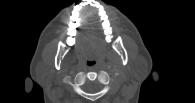 File:Benign mixed salivary tumor of the parotid gland (Radiopaedia 35261-36792 Axial bone window 18).jpg