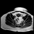 Benign seromucinous cystadenoma of the ovary (Radiopaedia 71065-81300 B 10).jpg