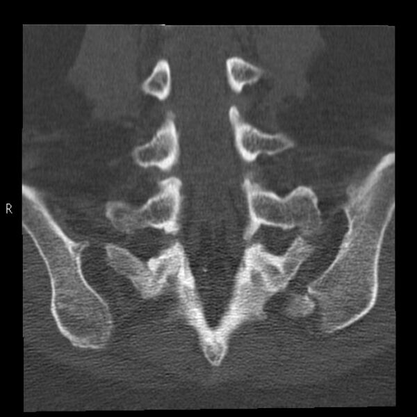 File:Bertolotti syndrome (Radiopaedia 24864-25128 Coronal bone window 32).jpg