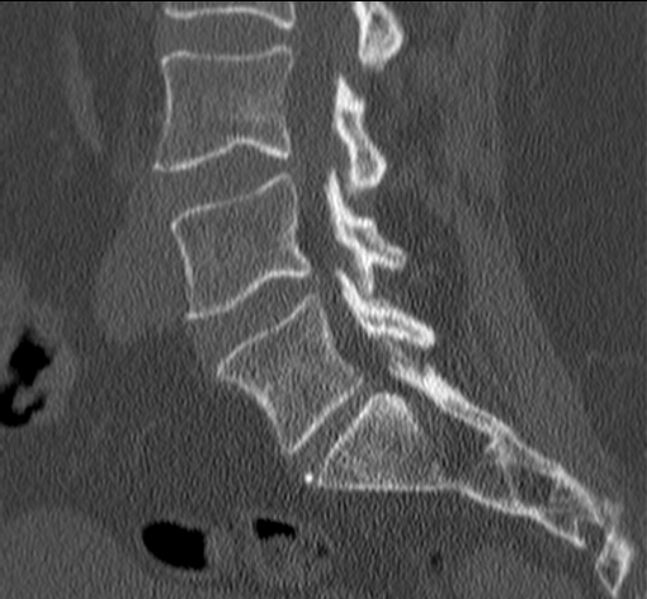 File:Bertolotti syndrome (Radiopaedia 24864-25128 Sagittal bone window 24).jpg