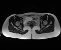 Bicornuate bicollis uterus (Radiopaedia 61626-69616 Axial T2 28).jpg