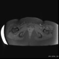 Bicornuate uterus- on MRI (Radiopaedia 49206-54297 Axial T1 fat sat 19).jpg