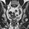 Bicornuate uterus (Radiopaedia 11104-11492 Coronal T2 13).jpg