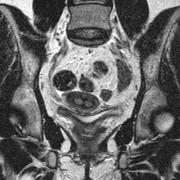 File:Bicornuate uterus (Radiopaedia 11104-11492 Coronal T2 13).jpg