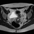 Bicornuate uterus (Radiopaedia 72135-82643 Axial T2 12).jpg