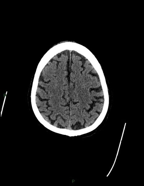 File:Bilateral acute middle cerebral artery territory infarcts (Radiopaedia 77319-89401 Axial non-contrast 69).jpg