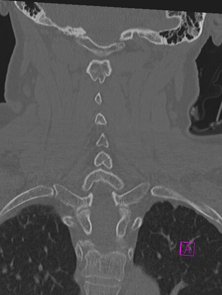 File:Bilateral atlanto-occipital assimilation (Radiopaedia 28350-28603 Coronal bone window 31).jpg