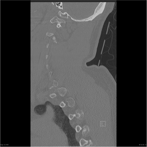 File:Bilateral cervical ribs (Radiopaedia 25868-26017 Sagittal bone window 15).jpg