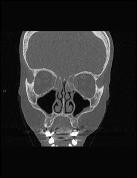 File:Bilateral frontal mucoceles (Radiopaedia 82352-96454 Coronal 134).jpg
