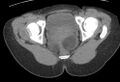 Bilateral mature cystic ovarian teratoma (Radiopaedia 88821-105592 Axial non-contrast 46).jpg