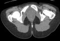 Bilateral mature cystic ovarian teratoma (Radiopaedia 88821-105592 Axial non-contrast 59).jpg