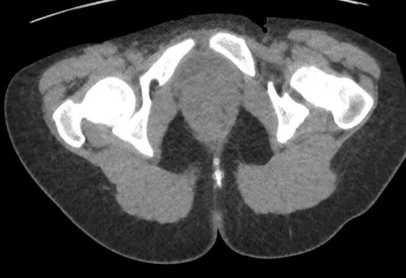 File:Bilateral mature cystic ovarian teratoma (Radiopaedia 88821-105592 Axial non-contrast 59).jpg