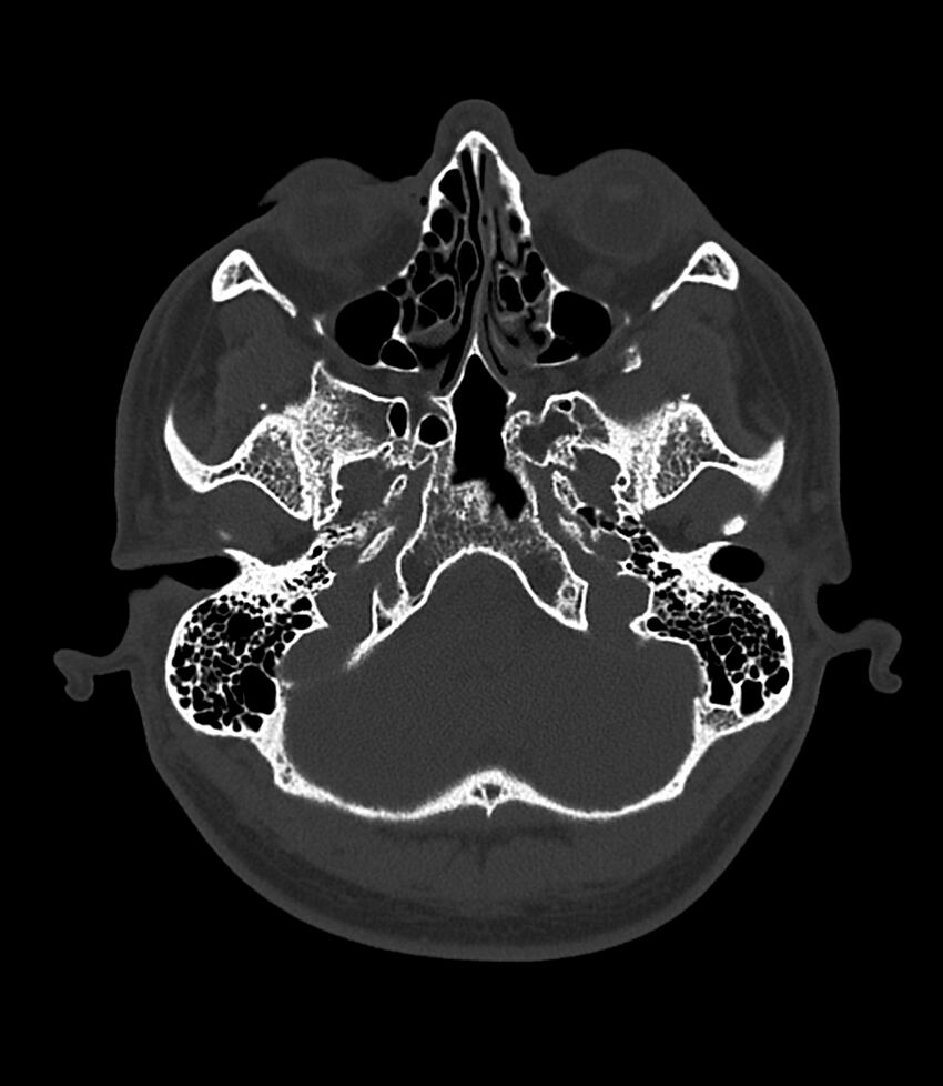 Bilateral medial canal fibrosis (Radiopaedia 85598-101344 Axial bone window 7).jpg