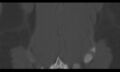 Bilateral pars defect (Radiopaedia 26691-26846 Coronal bone window 46).jpg