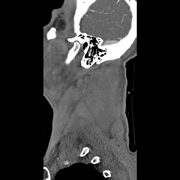File:Bilateral perched facets with cord injury (Radiopaedia 45587-49713 B 51).jpg