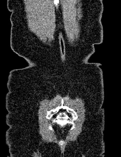 File:Bilateral staghorn calculi (Radiopaedia 59475-66842 Coronal non-contrast 91).jpg