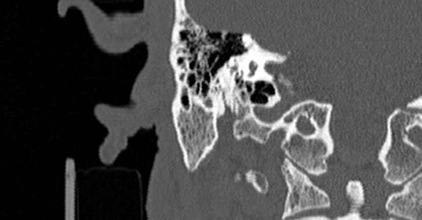 Bilateral temporal bone fractures (Radiopaedia 29482-29970 Coronal non-contrast 125).jpg
