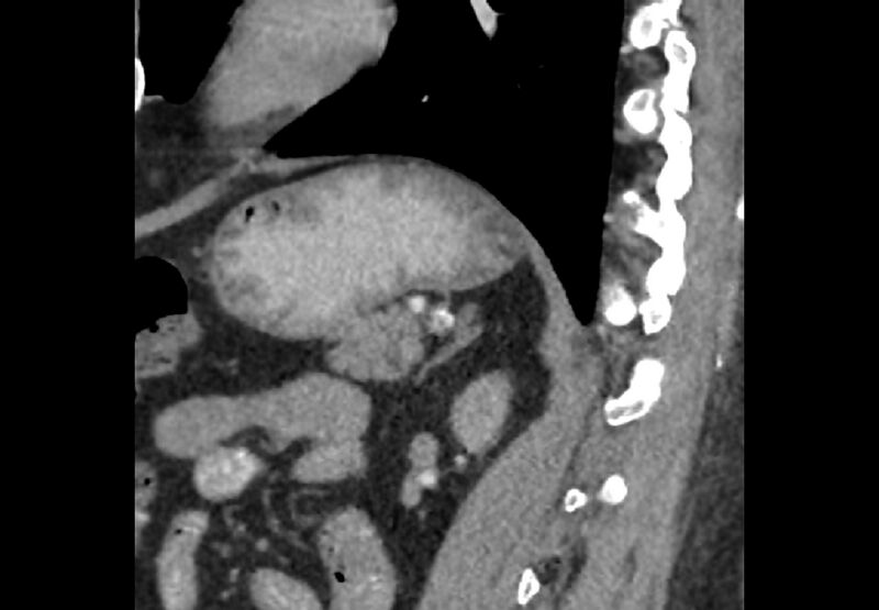 File:Bilateral urolithiasis with incidentally detected splenic artery aneurysm and left inferior vena cava (Radiopaedia 44467-48127 Ob. Sag. C+ Art. 32).jpg