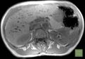 Biliary hamartomas (Radiopaedia 11235-11600 Axial T1 in-phase 1).jpg