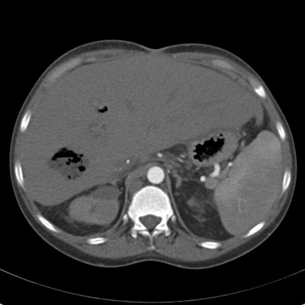File:Biliary necrosis - liver transplant (Radiopaedia 21876-21846 A 19).jpg