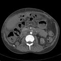 Biliary necrosis - liver transplant (Radiopaedia 21876-21846 A 34).jpg