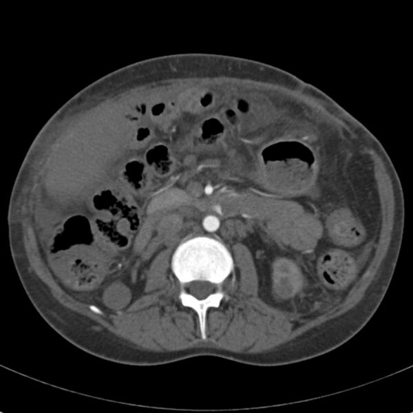 File:Biliary necrosis - liver transplant (Radiopaedia 21876-21846 A 34).jpg