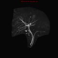 Biliary tree anatomical variant - biliary trifurcation (Radiopaedia 12531-12750 Coronal 3D MRCP 5).jpg