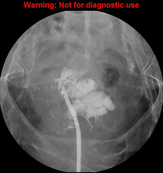 File:Bladder rupture (intraperitoneal) (Radiopaedia 41057-43807 cystogram 3).jpg