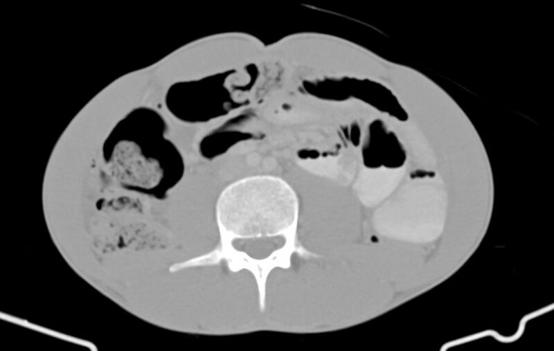 File:Blunt injury to the small bowel (Radiopaedia 74953-85987 Axial Wide 51).jpg