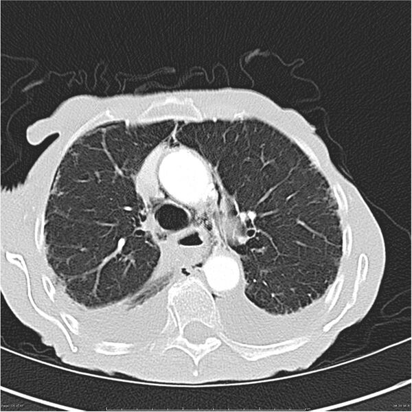 File:Boerhaave syndrome (Radiopaedia 26240-26362 Axial lung window 16).jpg