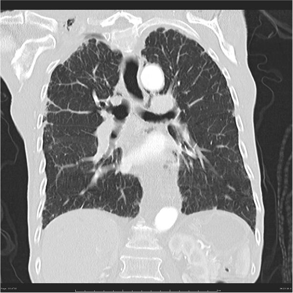 File:Boerhaave syndrome (Radiopaedia 26240-26362 Coronal lung window 19).jpg