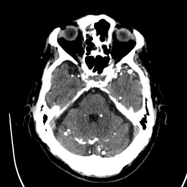 File:Brain Pantopaque remnants (Radiopaedia 78403-91048 Axial non-contrast 35).jpg