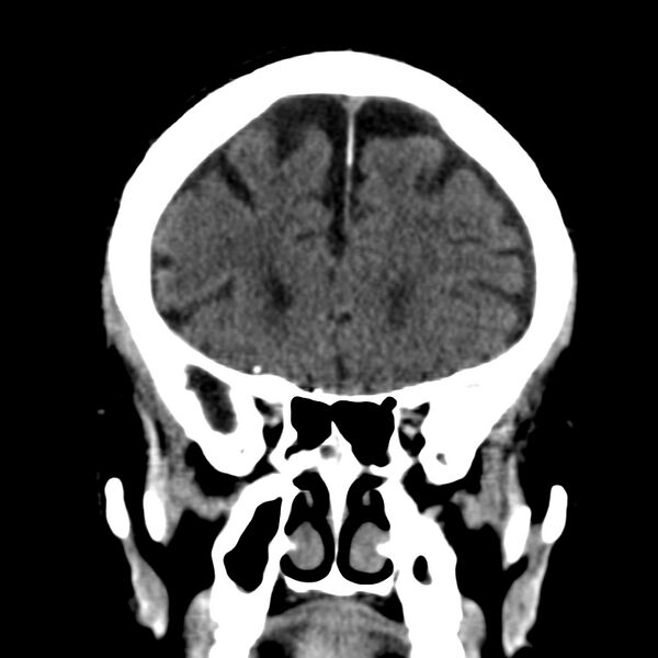 File:Brain Pantopaque remnants (Radiopaedia 78403-91048 Coronal non-contrast 22).jpg