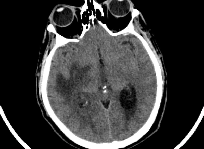 File:Brain abscess complicated by intraventricular rupture and ventriculitis (Radiopaedia 82434-96575 Axial non-contrast 32).jpg