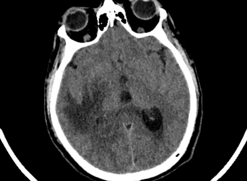Brain abscess complicated by intraventricular rupture and ventriculitis (Radiopaedia 82434-96575 Axial non-contrast 39).jpg