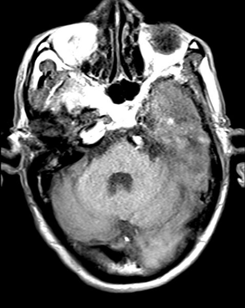 File:Brain abscess with dual rim sign (Radiopaedia 87566-103938 Axial T1 5).jpg