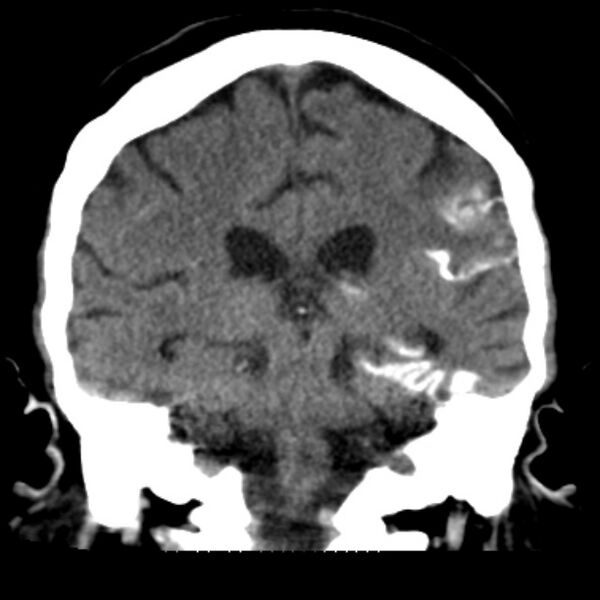 File:Brain cortical laminar necrosis (Radiopaedia 25822-25971 C 34).jpg
