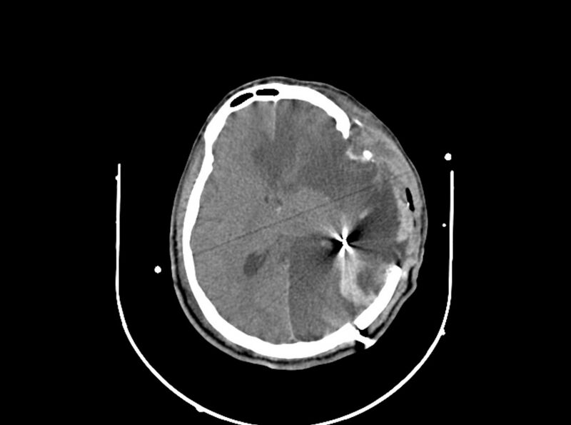 File:Brain injury by firearm projectile (Radiopaedia 82068-96087 B 110).jpg