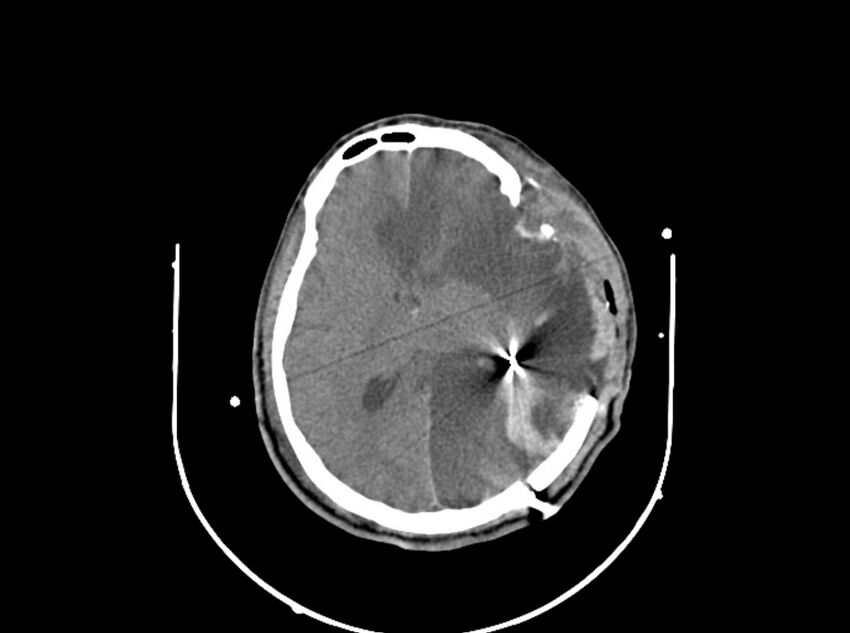 Brain injury by firearm projectile (Radiopaedia 82068-96087 B 110).jpg