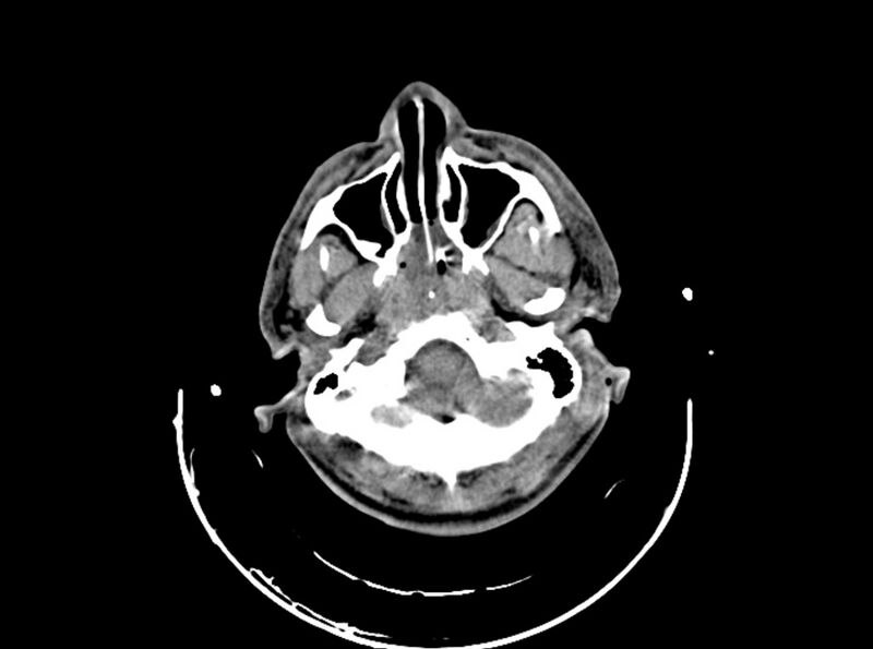 File:Brain injury by firearm projectile (Radiopaedia 82068-96087 B 48).jpg
