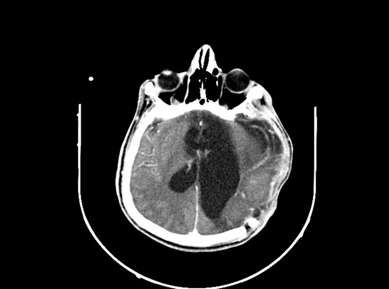 File:Brain injury by firearm projectile (Radiopaedia 82068-96088 B 132).jpg