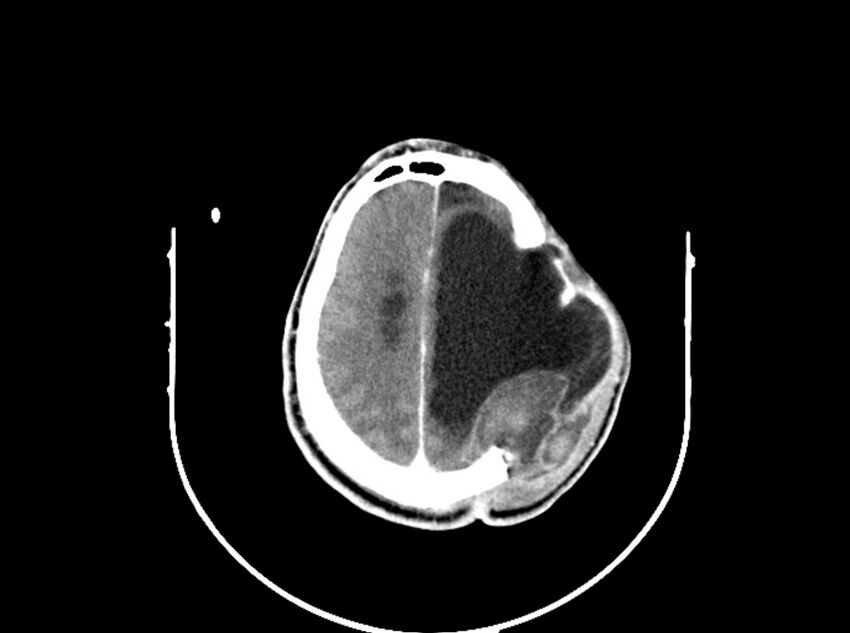 Brain injury by firearm projectile (Radiopaedia 82068-96088 B 168).jpg