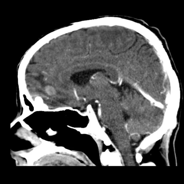 File:Brain metastases from lung cancer (Radiopaedia 24480-24781 C+ delayed 31).jpg