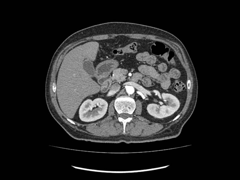 File:Brain metastases from renal cell carcinoma (Radiopaedia 42222-45328 A 71).jpg